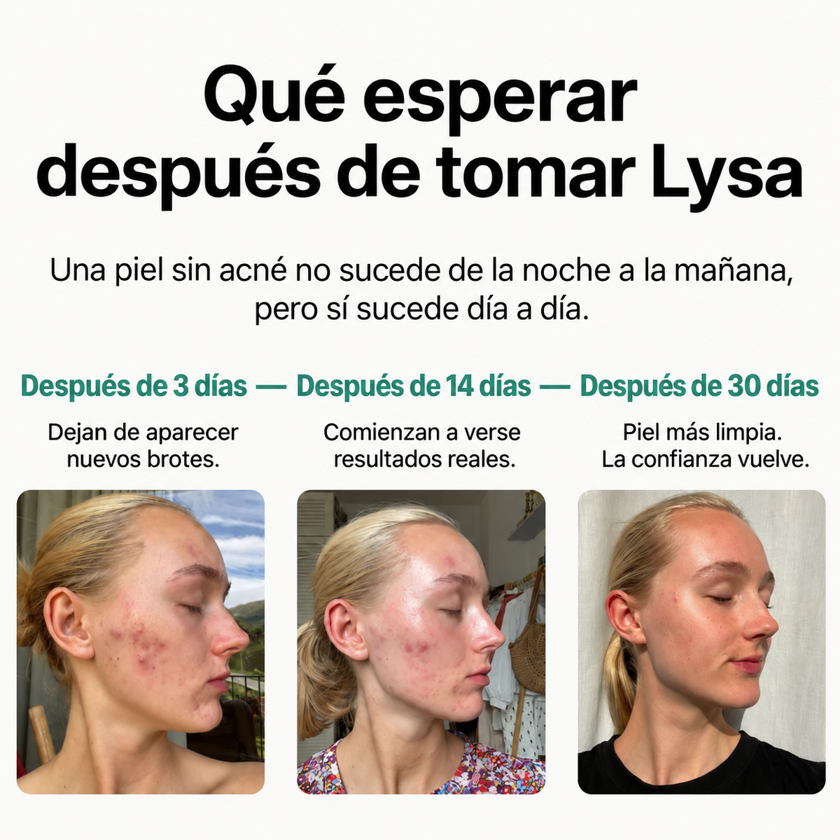 Gomitas Lysa para el acné